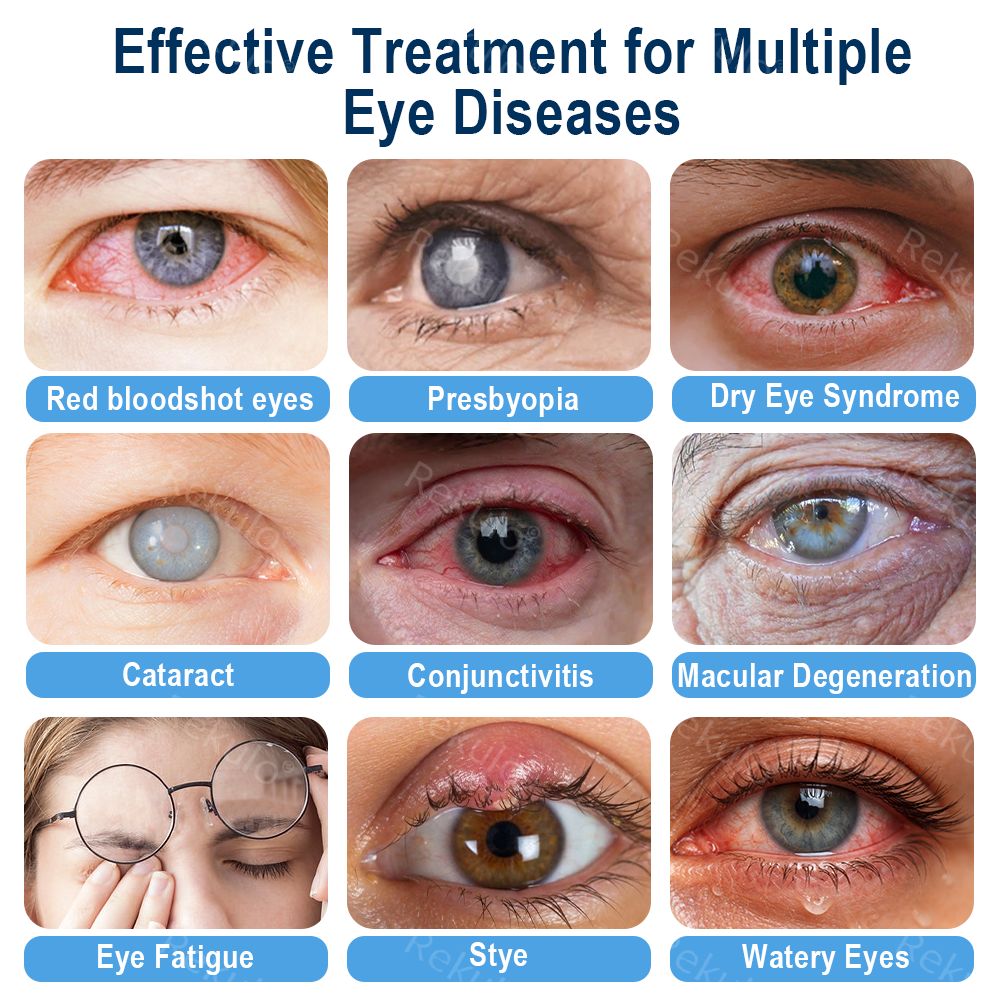 Rekulo® OptiMist Eye Spray✅FDA Approved (For dry eyes, blurry vision,presbyopia, and cataracts) 👀