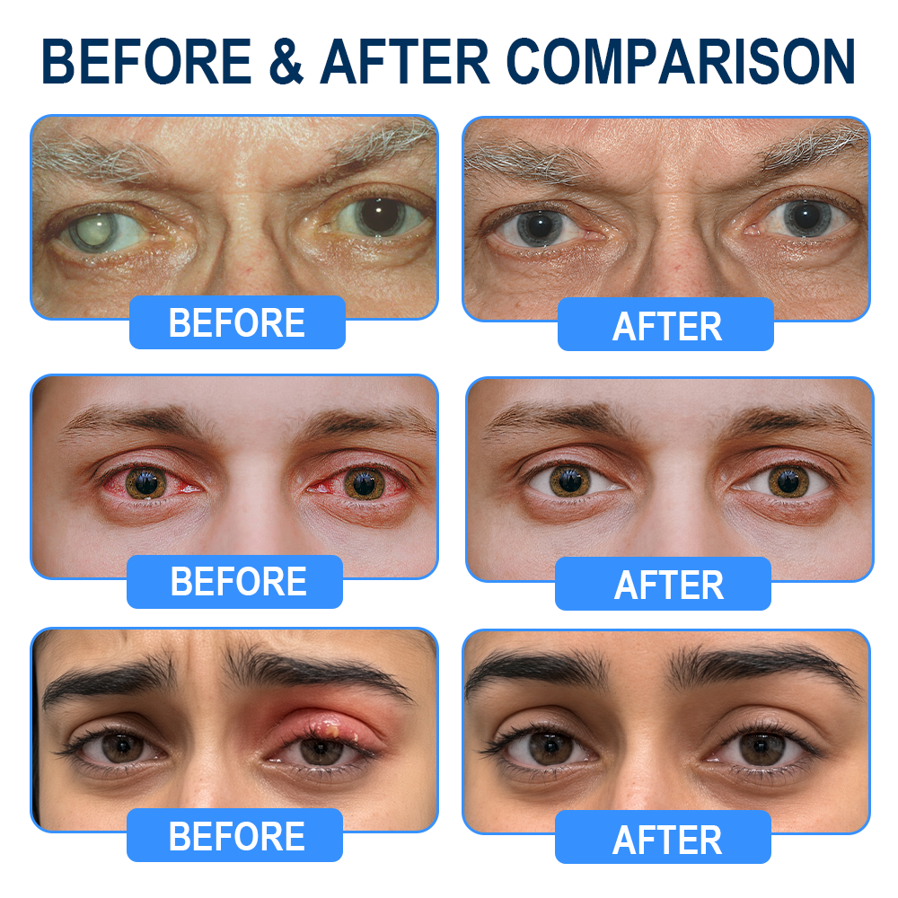 Rekulo® OptiMist Eye Spray✅FDA Approved (For dry eyes, blurry vision,presbyopia, and cataracts) 👀
