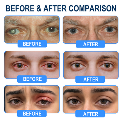 Rekulo® OptiMist Eye Spray✅FDA Approved (For dry eyes, blurry vision,presbyopia, and cataracts) 👀