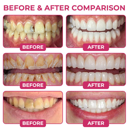 🔥TopSpire® DenPerm Cavity-Repair Natural Enamel Filling Gel
