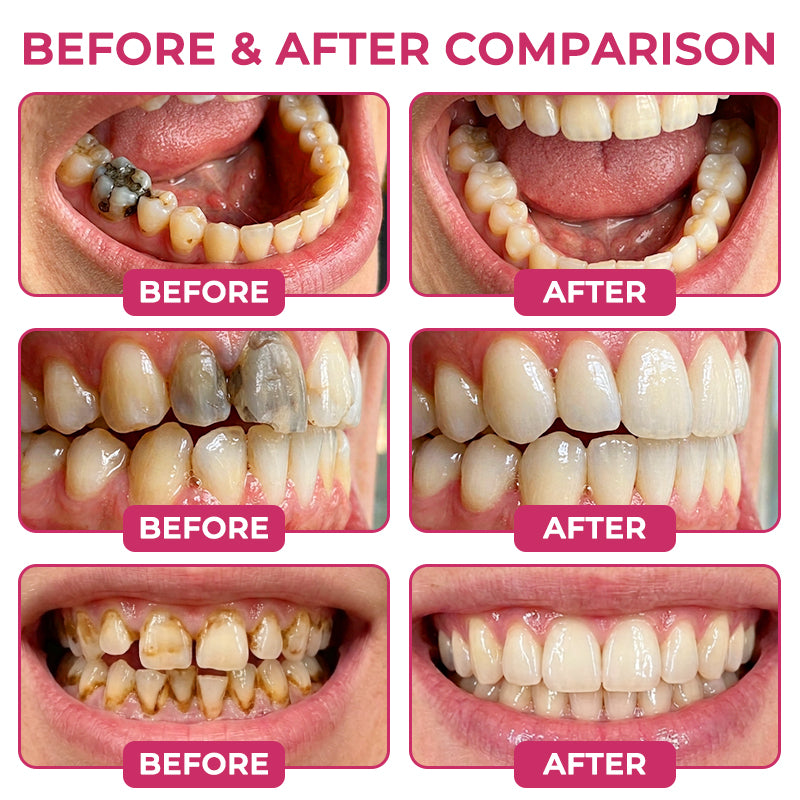 🔥TopSpire® DenPerm Cavity-Repair Natural Enamel Filling Gel